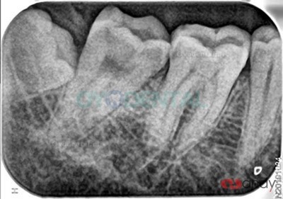 Handy HDS-500 PSP Scanner Digitale Fosforplaatscanner voor Tandheelkundige Beeldvorming